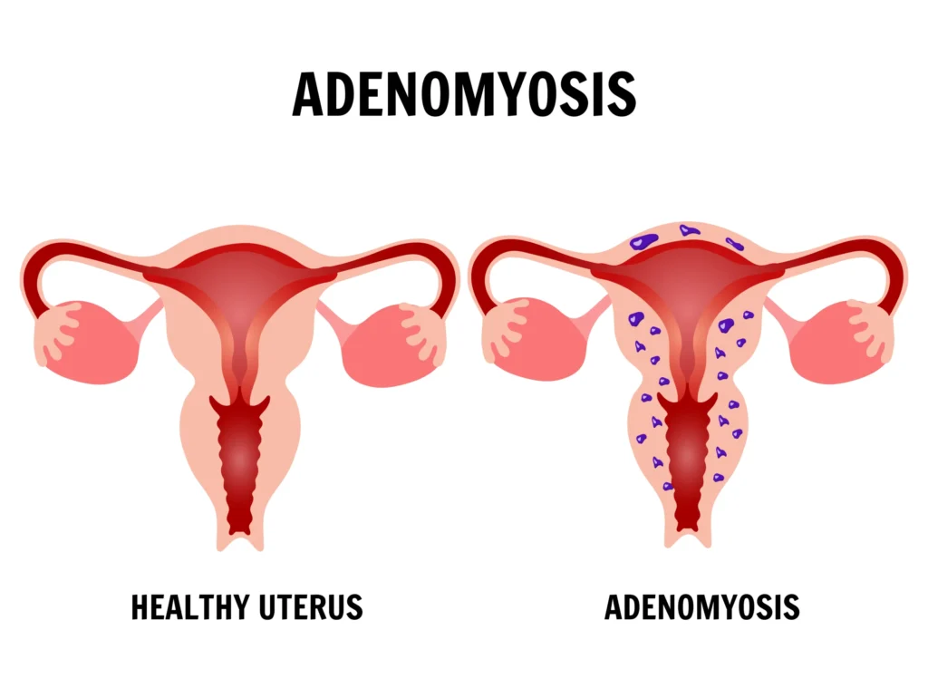 adenomyosis treatment in indore, best adenomyosis treatment doctor in indore