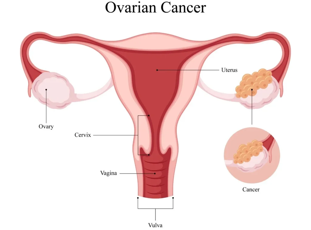 Cervical Cancer