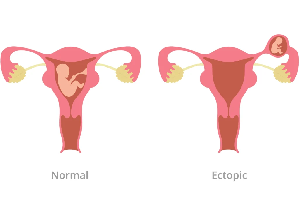 Ectopic Pregnancy, ladies doctor indore, best gynae in indore, best gynecologist doctor in indore