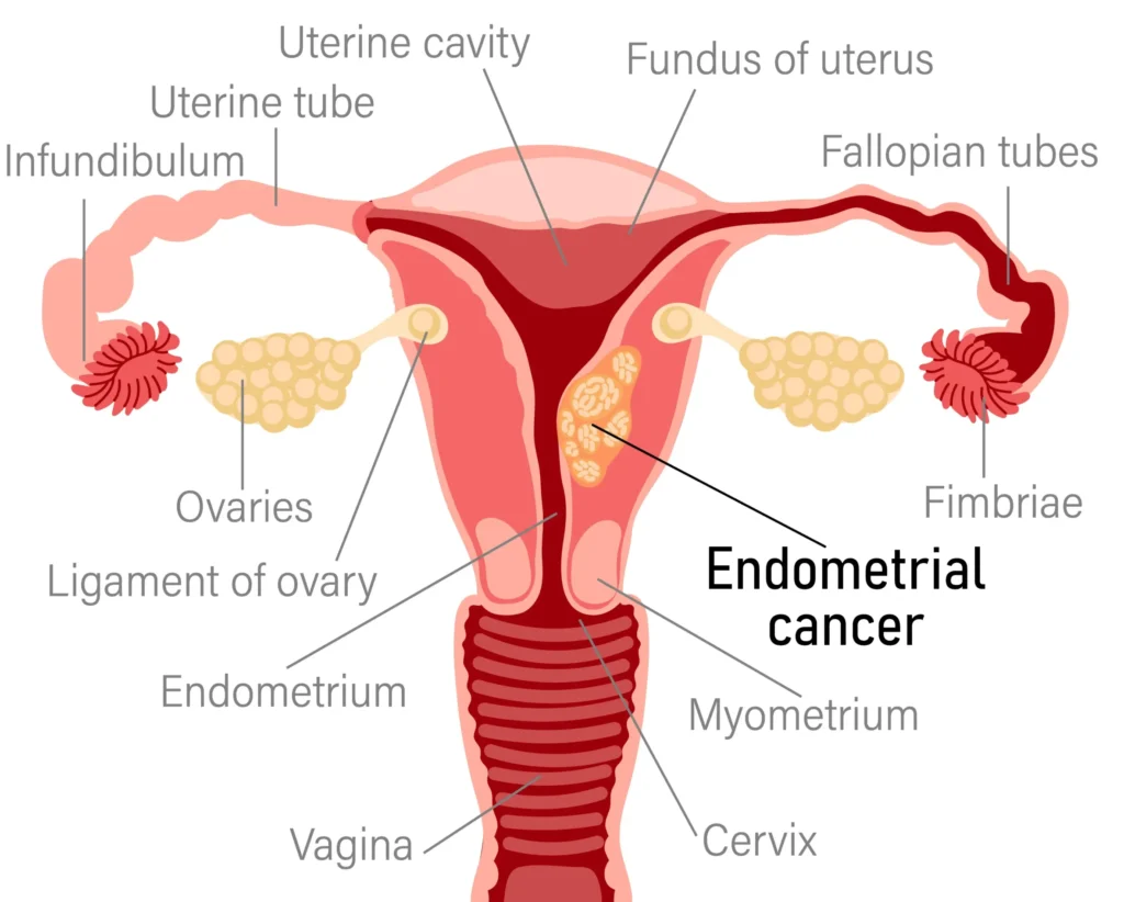 Uterine Cancer